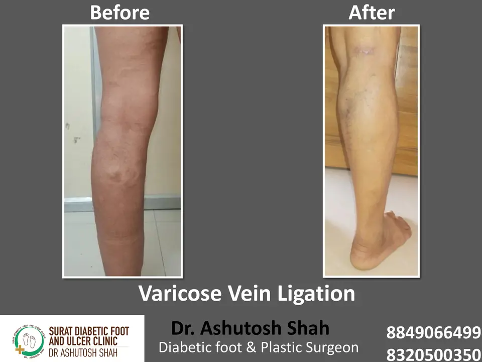 Varicose veins and Ulcers.pptx-11.webp